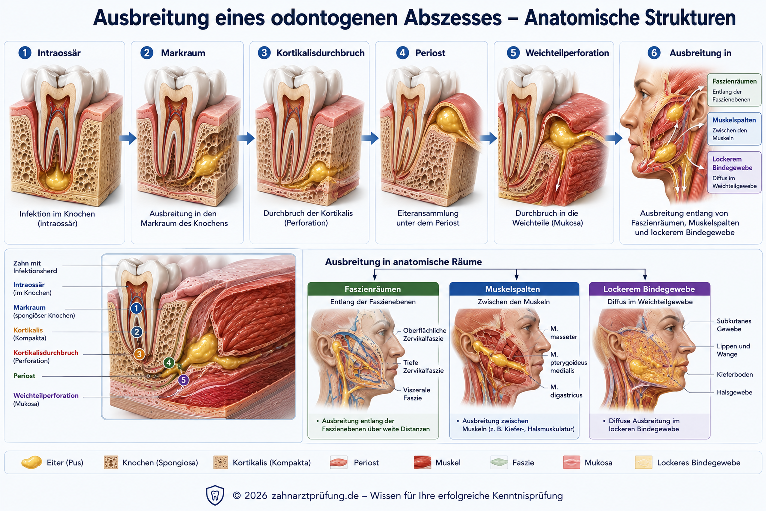 Klinische Progression einer odontogenen Infektion: periapikal, enossal, subperiostal, submukös und Logenabszess